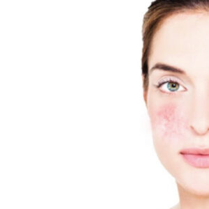 REDNESS / ROSACEA PRONE